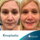 Slider image (10) Dra. Renata Cardenas-Aesthetic & Fuctional Rhinoplasty
